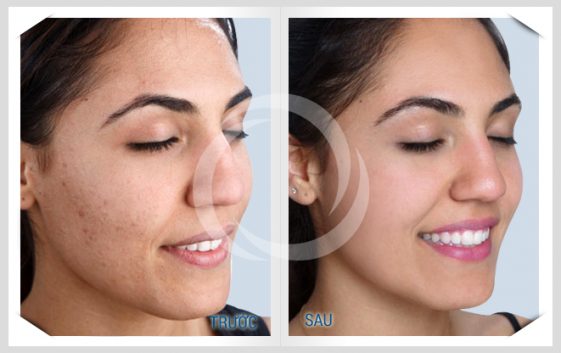Hình ảnh bạn Trần Nhật Linh (Hà Nội) trị mụn trứng cá cách đây 3 tháng