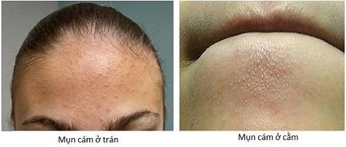 cach-tri-mun-tan-goc