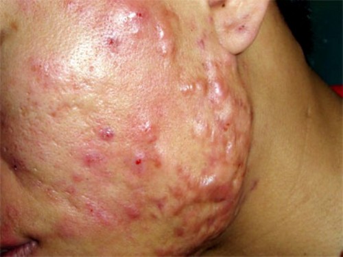 mụn trứng cá lồi