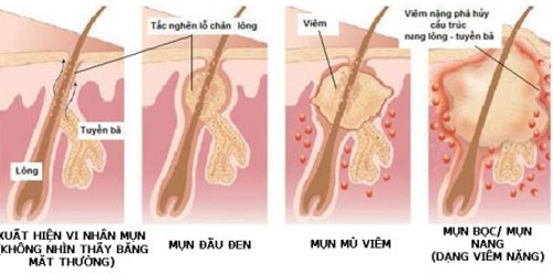 Cách trị mụn cho nam an toàn, triệt để nhất