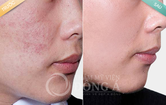 Kết quả trị mụn hieu-qua-tri-mun-tan-goc