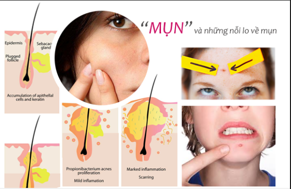 nguyen-nhn-gay-mun-tuoi-day-thi