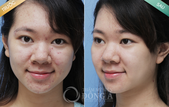 Kết quả thực tế của khách hàng sau trị mụn bằng công nghệ laser Acne tri-mun-tuoi-day-thi-2