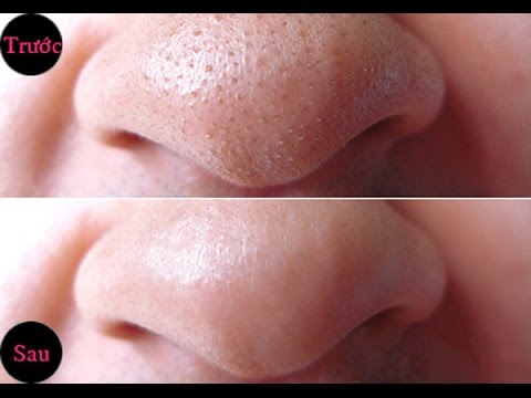 cach-lam-het-mun-dau-den