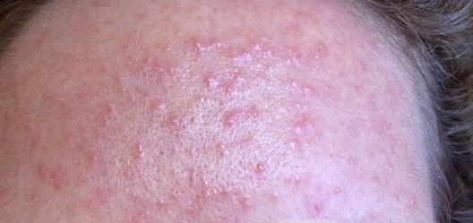 cach-tri-mun-tren-tran