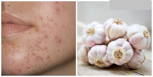 cach-tri-mun-bang-toi