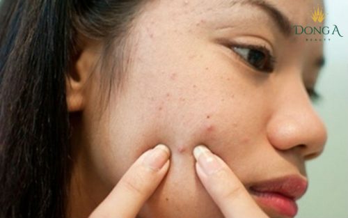 Thuốc trị mụn erossan không mang lại hiệu quả triệt để thuoc-tri-mun-erossan-co-tot-khong