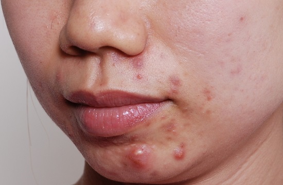 Mụn trứng cá bội nhiễm ảnh hưởng nặng đến tính thẩm mỹ của da Mụn trứng cá bội nhiễm ảnh hưởng nặng đến tính thẩm mỹ của da