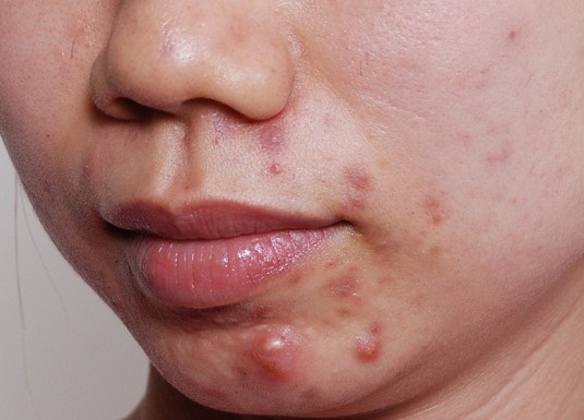 vị trí mụn mọc trên mặt nói lên điều gì