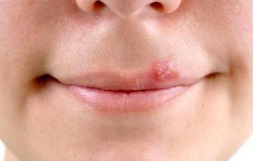 vị trí nổi mụn trên mặt nói lên điều gì