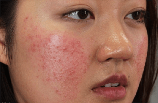 trị mụn trứng cá cho da nhạy cảm trị mụn trứng cá cho da nhạy cảm