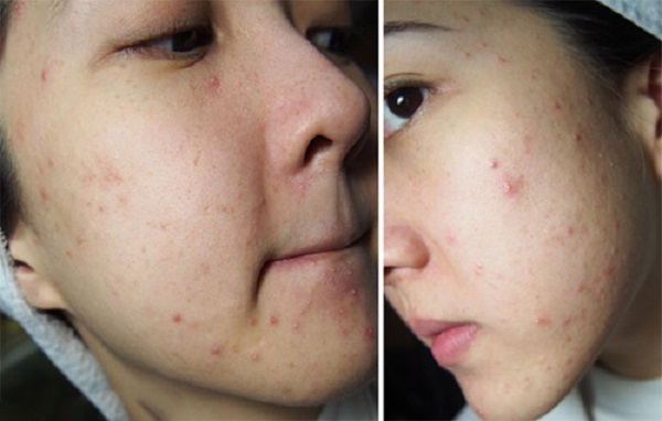 Laser Acne là công nghệ ưu việt nhất trong điều trị mụn trứng cá cho da nhạy cảm trị mụn trứng cá cho da nhạy cảm