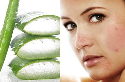 Trị mụn bằng nguyên liệu tự nhiên