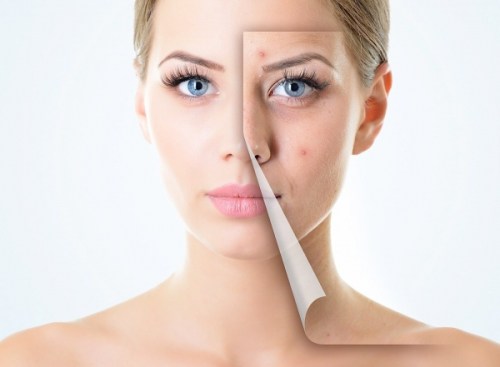 Trị mụn như thế nào mới tốt? Trị mụn như thế nào mới tốt?
