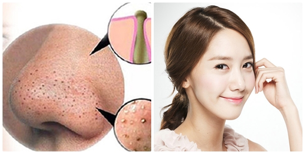 Cách trị mụn đầu đen ở mũi triệt để nhất
