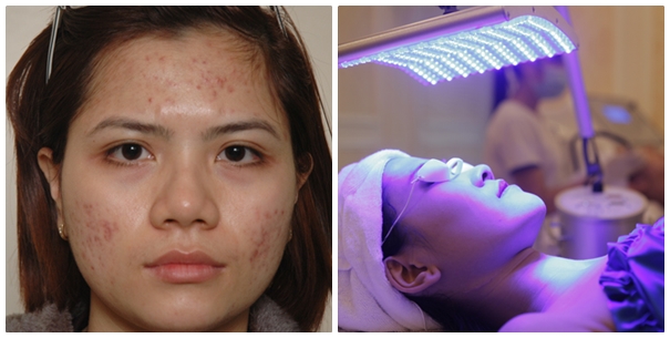 Hướng dẫn từ A-Z các cách trị mụn ở má Hiệu quả