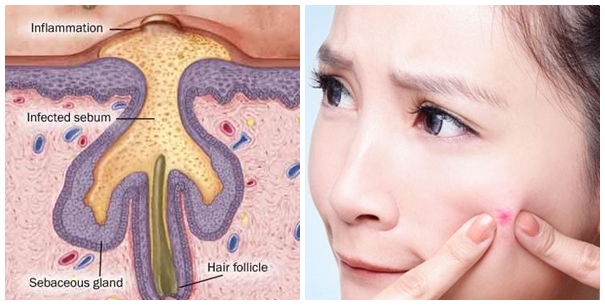 Mách bạn cách chữa trị mụn bọc triệt để nhất hiện nay