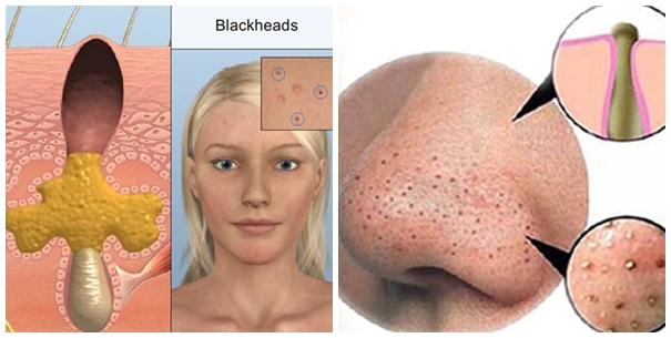 Cách chữa mụn đầu đen hiệu quả cho mọi loại da