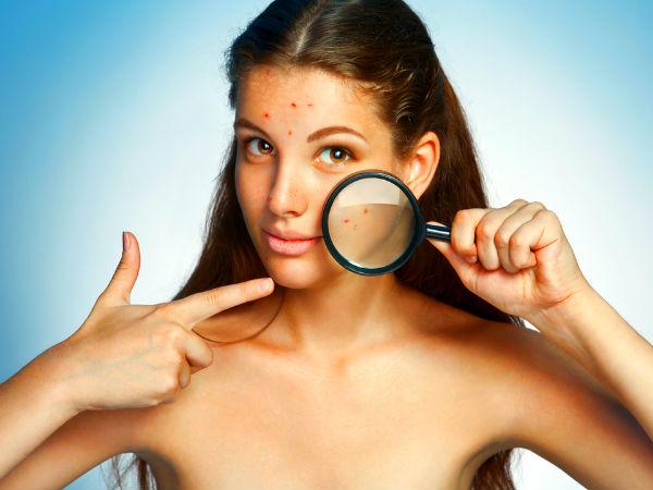 Làm sao để hết được mụn đầu đen mà không tái phát?