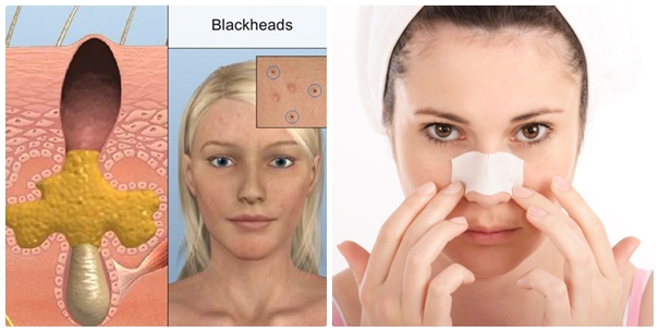 Sử dụng miếng dán lột mụn đầu đen có tốt không?