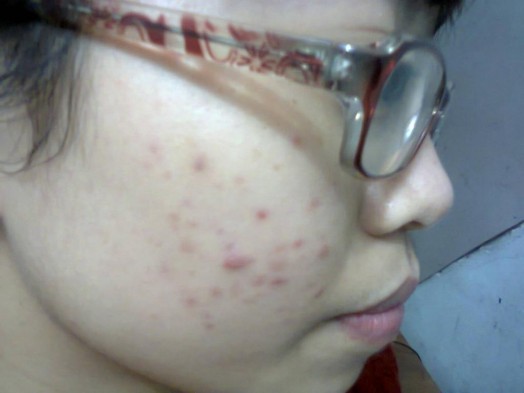 Giải pháp trị mụn tuổi dậy thì hiệu quả dứt điểm sau 3 tuần