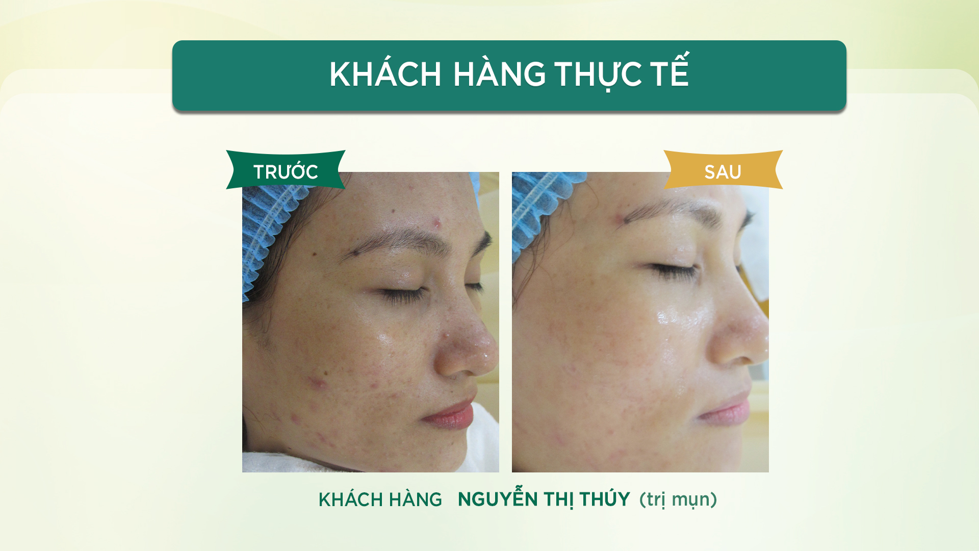 Tại sao chuyên gia khuyên nên trị mụn bằng công nghệ ánh sáng Laser?