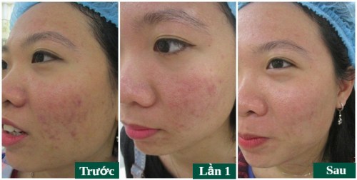  trị mụn acne remove tại đông á