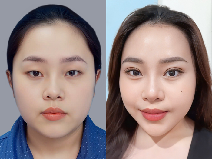 Kết quả của khách hàng sau khi cắt mí tại Kangnam