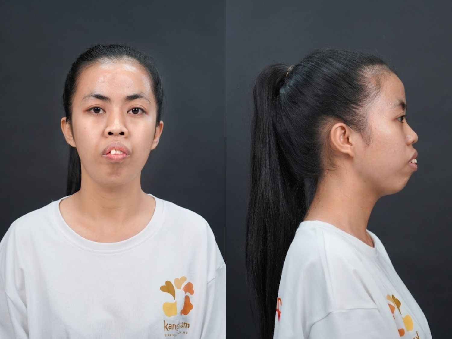 Tình trạng hàm hô nặng của Trà My trước phẫu thuật