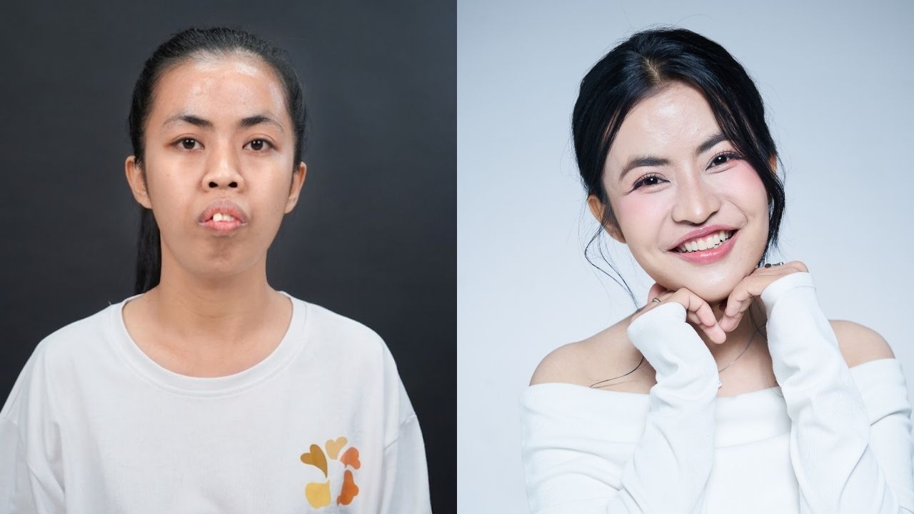 Chỉnh hàm hô là phương pháp phẫu thuật can thiệp trực tiếp vào cấu trúc xương hàm